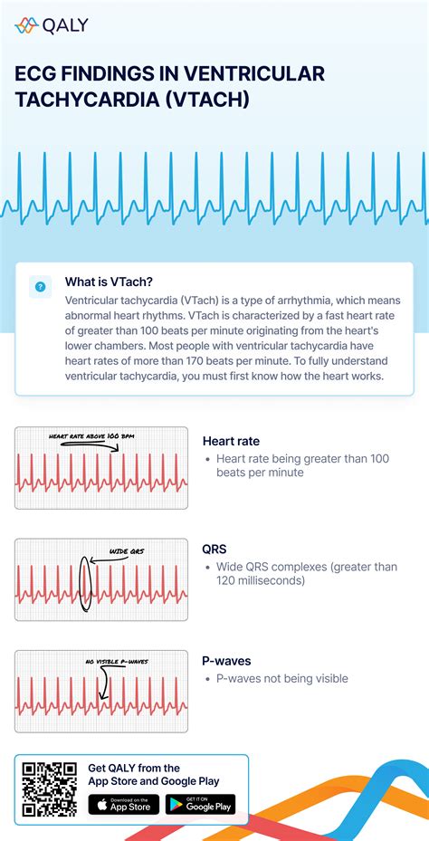 Ventricular Tachycardia Ecg What Is Tachycardia? Symptoms, Causes,