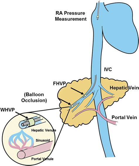 Portal Hypertension and Related Complications: Diagnosis and Management - Mayo Clinic Proceedings