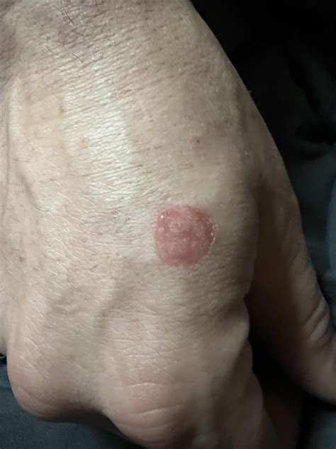 Ring Worm? : r/medical