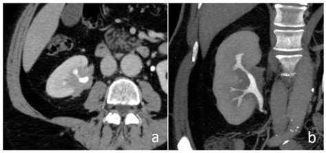 CT Urography Findings of Upper Urinary Tract Carcinoma and Its ...