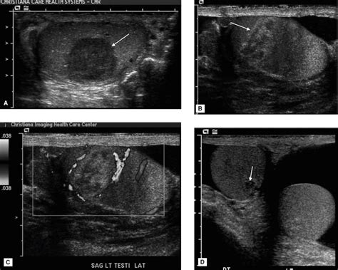 Scrotal Cysts Ultrasound