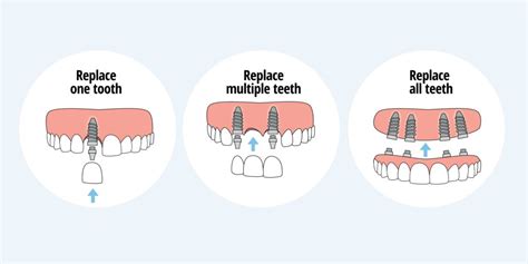 Image result for Different Types of Teeth Implants