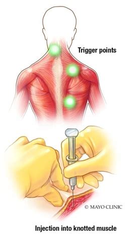 Trigger Point Injections 的图像结果