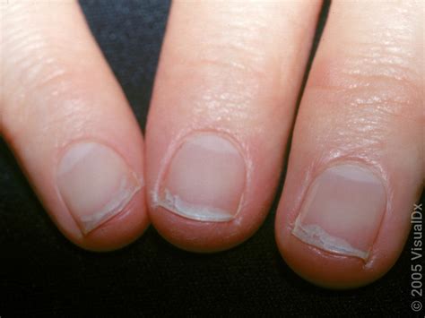 How to Fix Split Nails 的图像结果