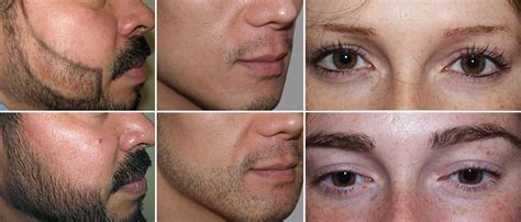 Facial Hair Transplant - Beard, Moustache, Eyebrow Hair Transplant ...
