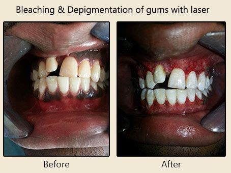 Treatment for Periodontal Diseases | Flap Surgery | Laser Periodontal ...