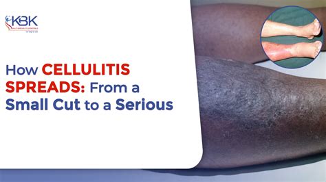 Cellulitis: From Cut to Infection