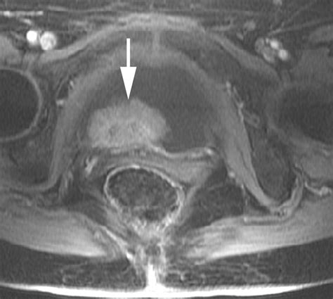 Dynamic MRI of Bladder Cancer: Evaluation of Staging Accuracy | AJR
