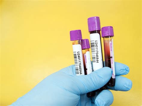 Aids Hilfe Wien bietet gratis Hepatitis-C-Tests an - VIENNA.AT