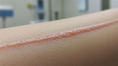 The Sun & Scars: How Does Sunlight Affect The Scar Healing Process? – Rejûvaskin