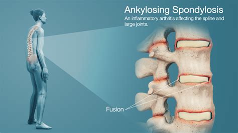 Ankylosing Spondylitis Treatment