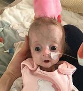 Image result for Progeria Babies