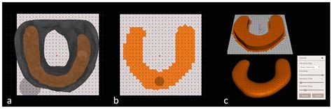 3D-Printed Overlay Template for Diagnosis and Planning Complete Arch ...