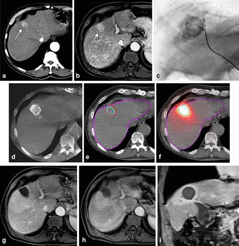 Yttrium-90 Radiation Segmentectomy of Hepatocellular Carcinoma: A ...