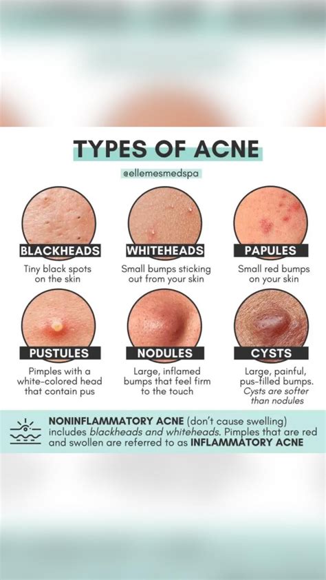 Types of acne the differences between your bumps and blemishes – Artofit