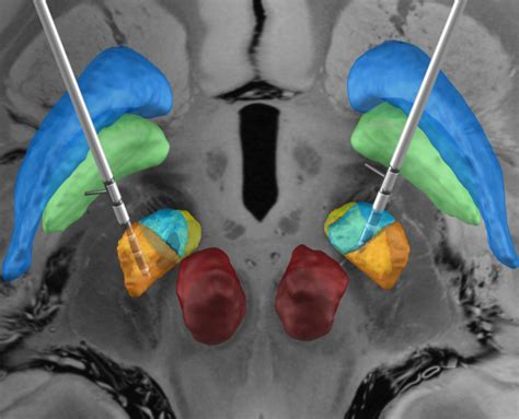 Image result for DBS Tutorial