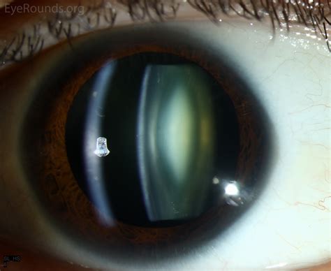 Kuvatulokset haulle cataract