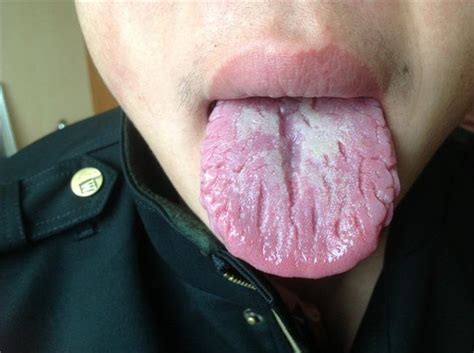 裂纹舌原因 什么原因导致裂纹舌 裂纹舌是啥原因 _第二人生