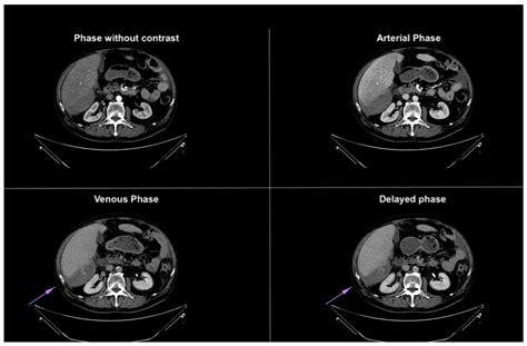 Atraumatic Hepatic Laceration with Hemoperitoneum