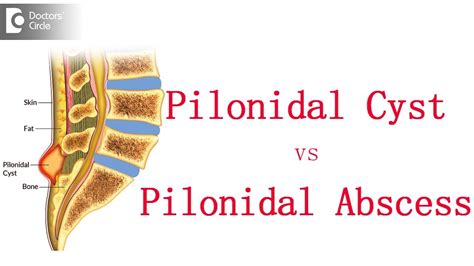 Why Are Pilonidal Cysts So Painful at Anthony Barajas blog