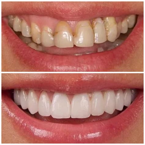 Veneer Treatment Teeth