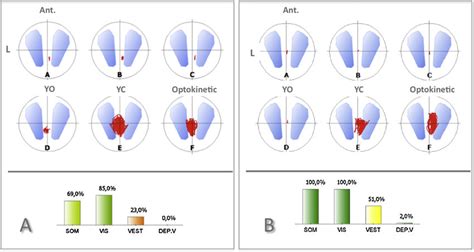 Image result for Computerized Dynamic Posturography
