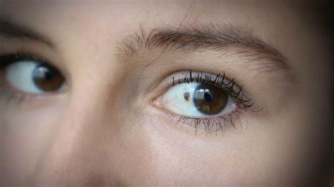 Expert Eye Freckle Removal in London
