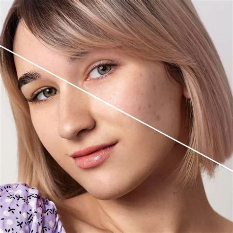 Fractional CO2 Laser for Scars in Jaipur: Effective Scar Reduction ...