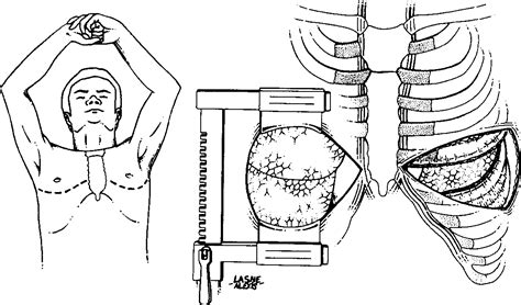 Image result for Clamshell Thoracotomy