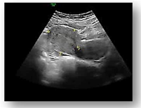 9 Week Ectopic Pregnancy Ultrasound