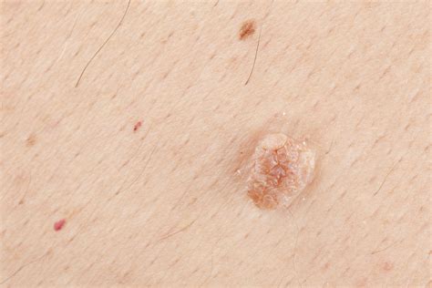 Genital Wart Vs Skin Tag