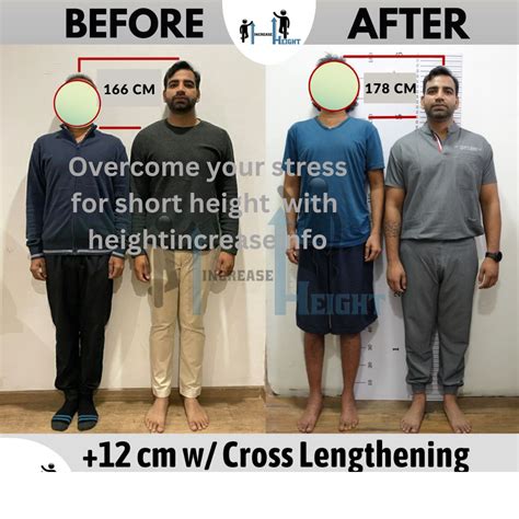 Limb Lengthening Surgery: What Will It Cost You?