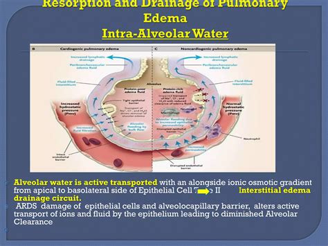 Pulmonary Edema: Fluids or Diuretics? | PPT