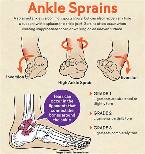 Ankle Sprain: Cause, Symptoms and Treatment