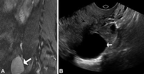 Benign-appearing Incidental Adnexal Cysts at US, CT, and MRI: Putting the ACR, O-RADS, and SRU ...