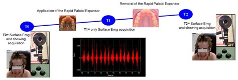 Effects of Rapid Palatal Expansion on Chewing Biomechanics in Children ...