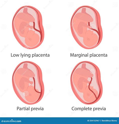 Placenta Previa Types