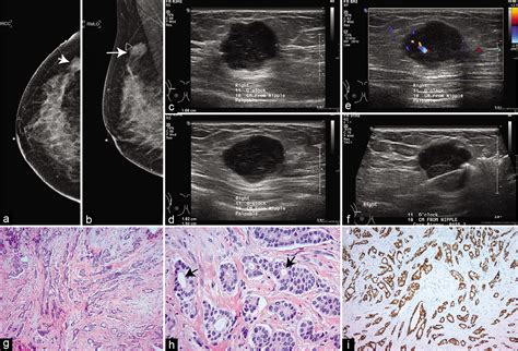 Breast Cancer Malignant Ultrasound Images