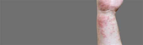 Psoriasis Treatment in Bangalore | DNA Skin Clinic