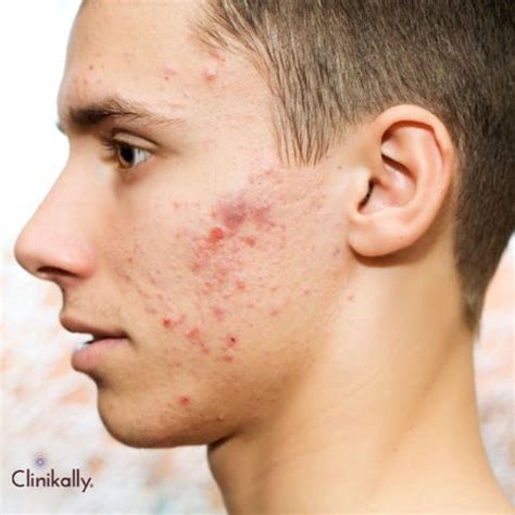 Hormonal vs Bacterial Acne: How to tell the difference | Clinikally