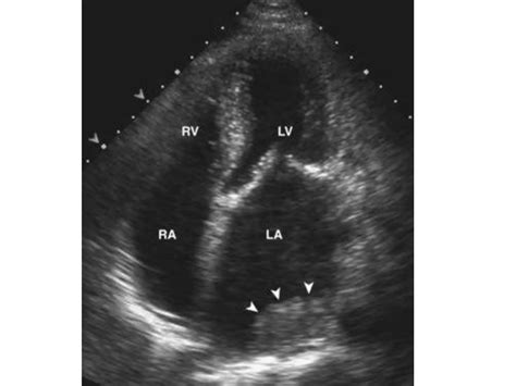 Echo Mitral Stenosis | PPTX