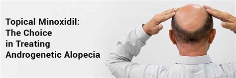 Topical Minoxidil: The Choice in Treating Androgenetic Alopecia