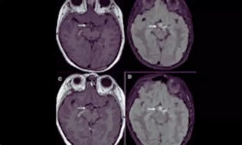 Beetroot Compound Betanin Promising as Safe, Natural Alternative to ...
