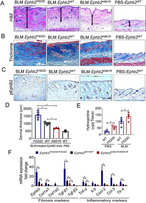 EphB2 Receptor Promotes Dermal Fibrosis in Systemic Sclerosis - Egal - 2024 - Arthritis ...