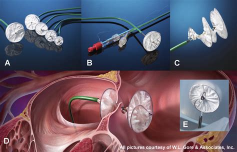 Pfo Closure Device