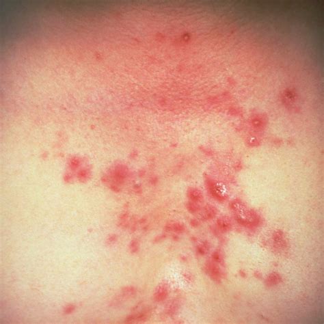 Different Types of Inflamed Acne Pimples