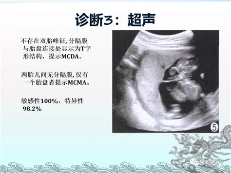 双胎及多胎妊娠综述_发生率