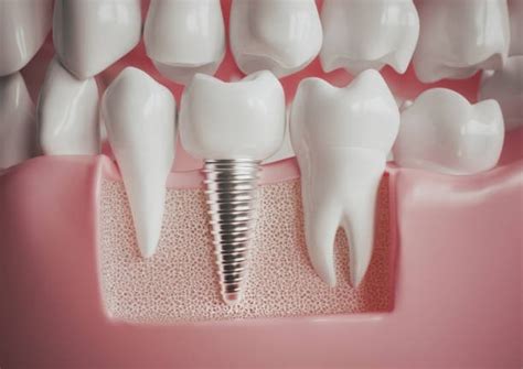 Interesting Statistics About Dental Implants You’ll Want to Know Before ...