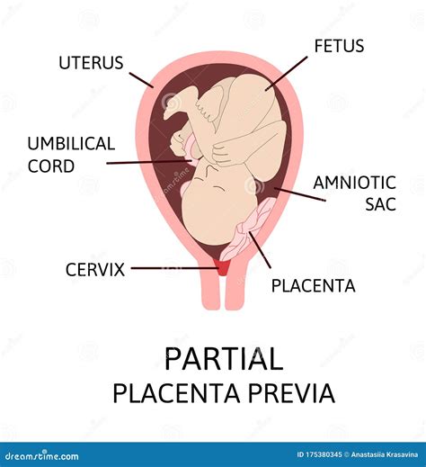 Different Placental Locations during Pregnancy. Major and Normal Placenta Previa, Total and ...