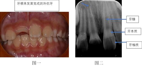 门牙被撞松动了还能长好吗？门牙磕掉一半修复费用是多少,牙齿对比照片-8682赴韩整形网